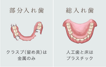 「部分入れ歯」クラスプ（留め具）は金属のみ　「総入れ歯」人工歯と床はプラスチック